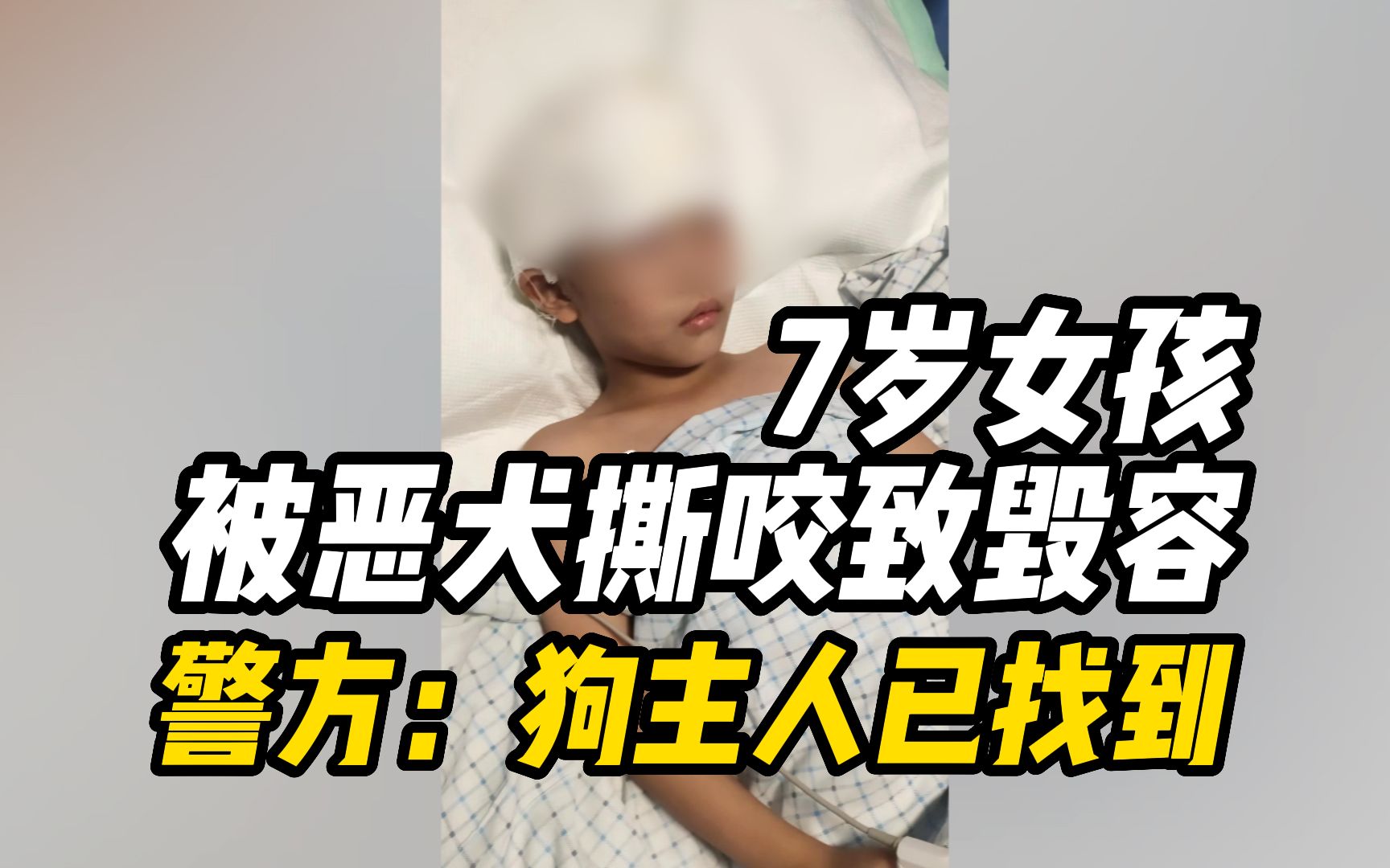 安徽男子自述7岁女儿被恶犬撕咬致毁容:做了近六个小时手术哔哩哔哩bilibili