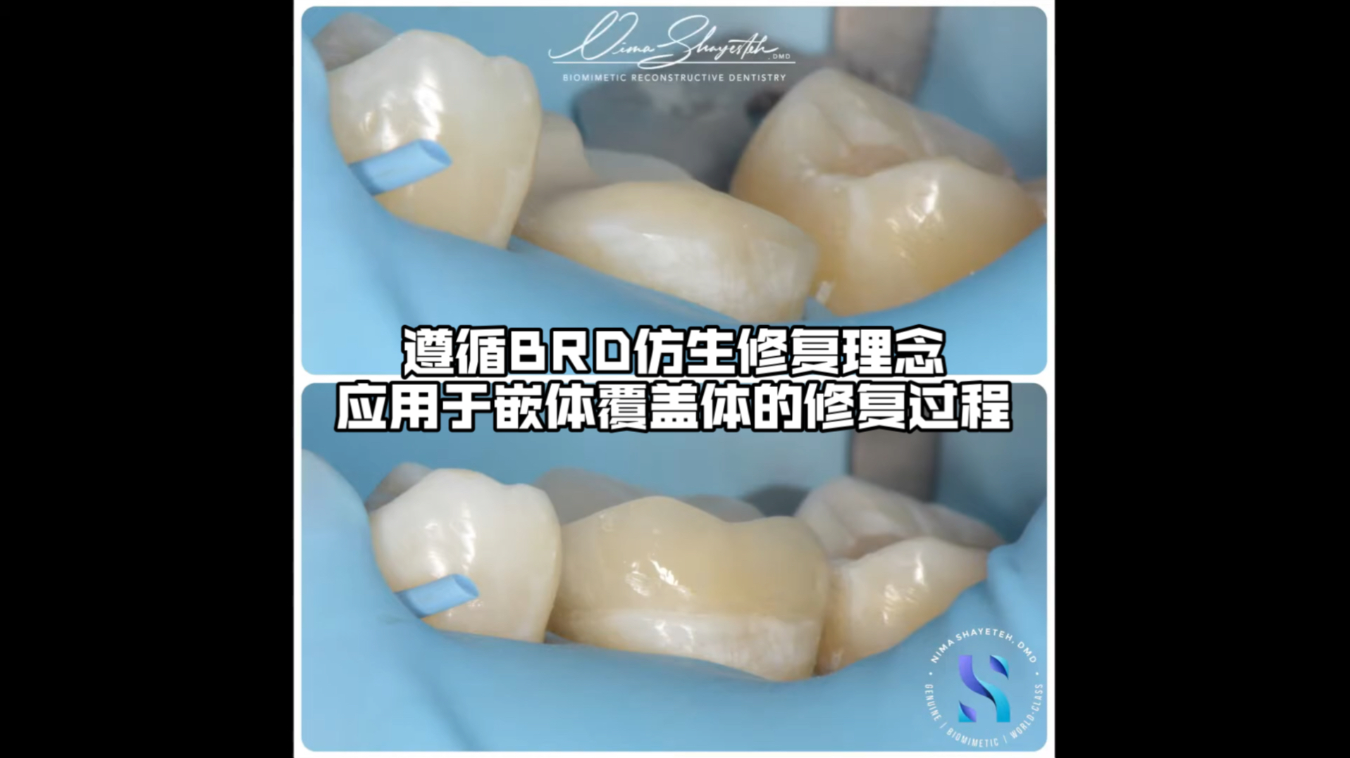 遵循BRD仿生修复理念应用于嵌体覆盖体的修复过程—Dr. Nima Shayesteh#BRD#仿生修复学哔哩哔哩bilibili