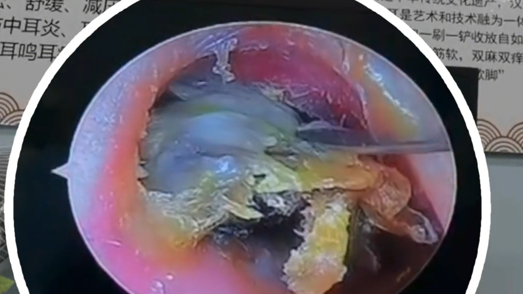 恐怖胆脂瘤、耳道被扎出一个大洞 从洞里挖出好大一坨狠货哔哩哔哩bilibili