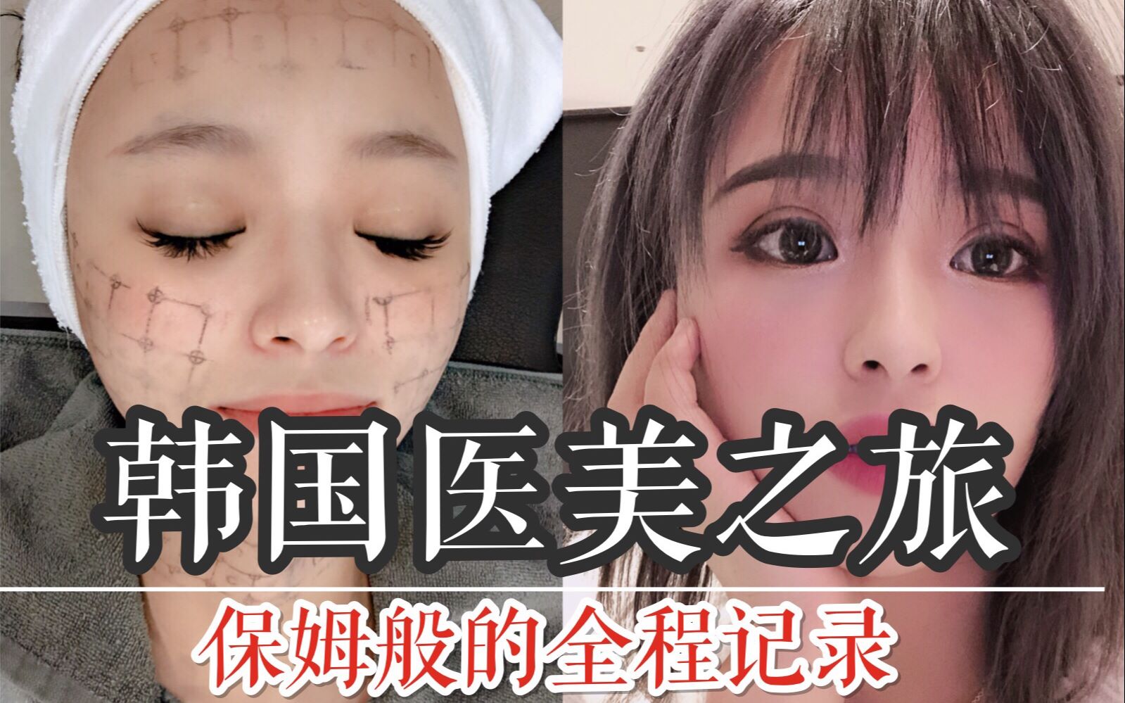 花了280万韩币的韩国医美体验,被容嬷嬷戳了20针真的很痛!