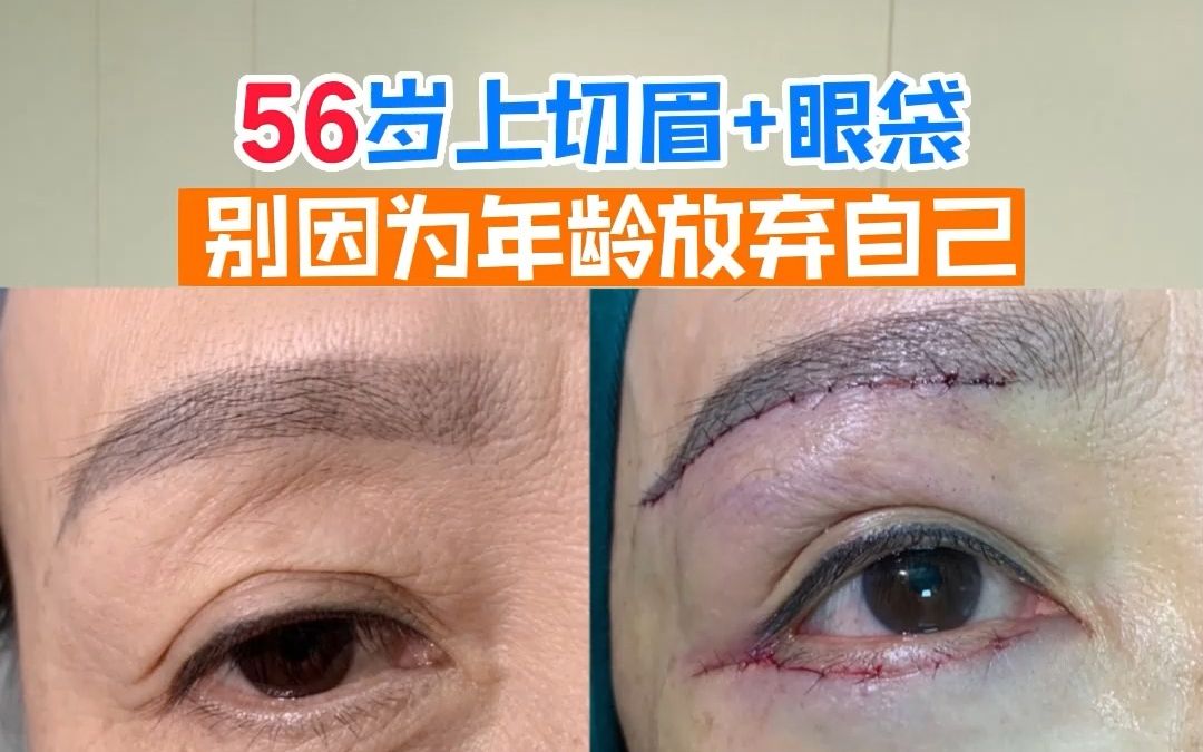 56岁切眉术和祛眼袋术后,你觉得效果怎么样?哔哩哔哩bilibili