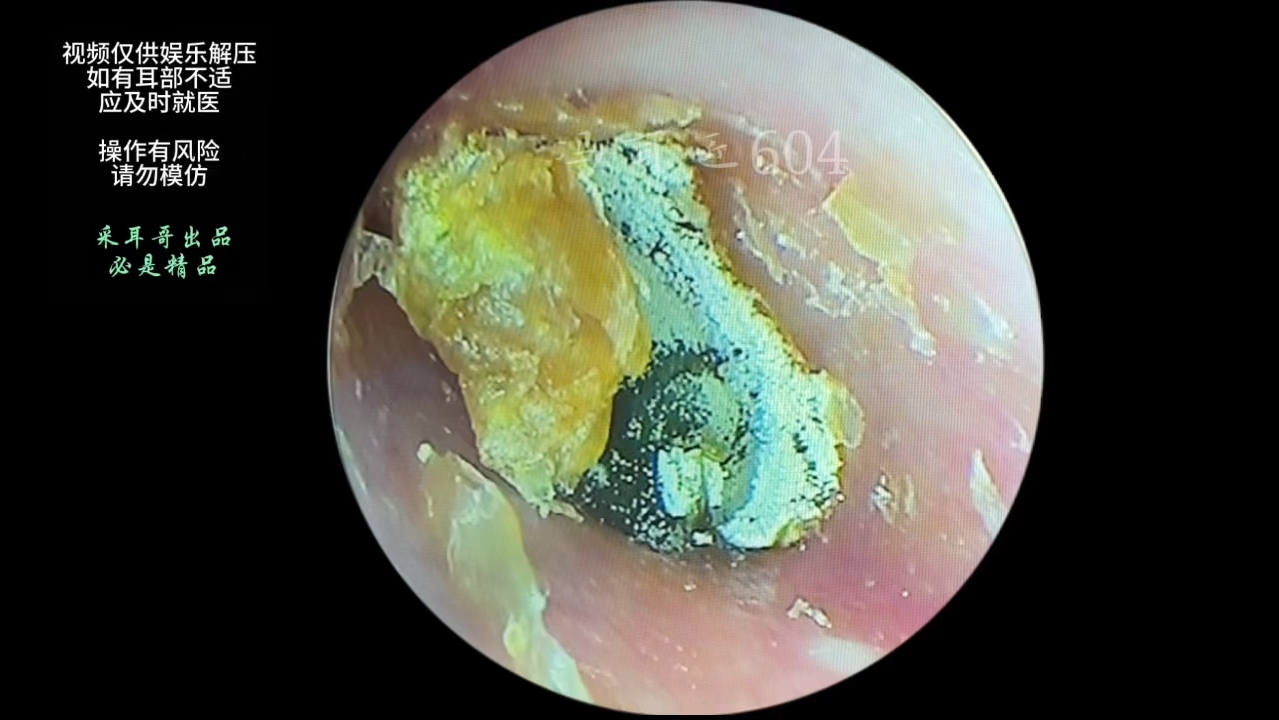耳道发霉厚干片