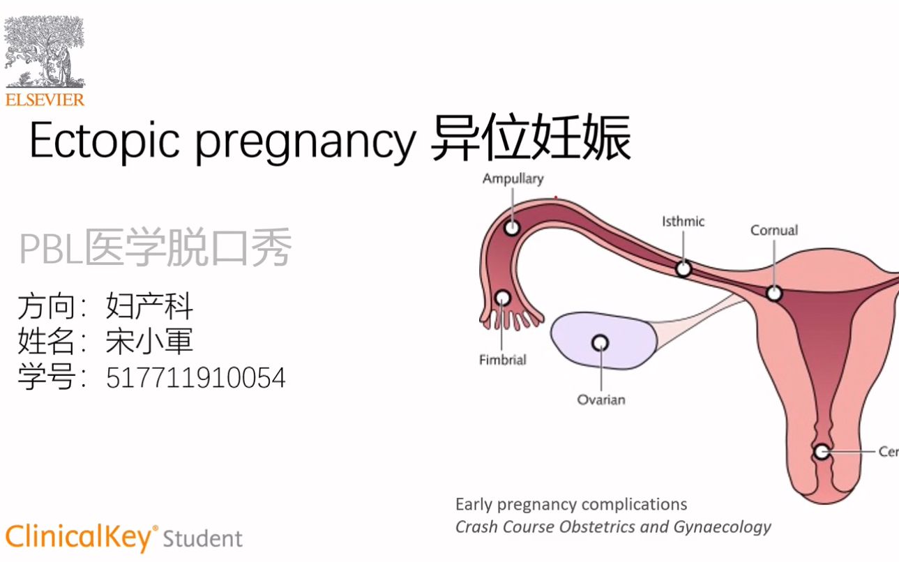 [图]【PBL医学脱口秀】异位妊娠-宋小军