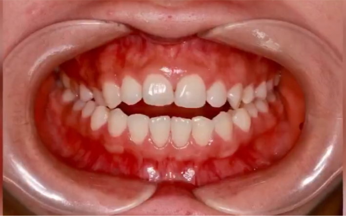 中山牙齿矫正案例分享开颌矫正的前后对比