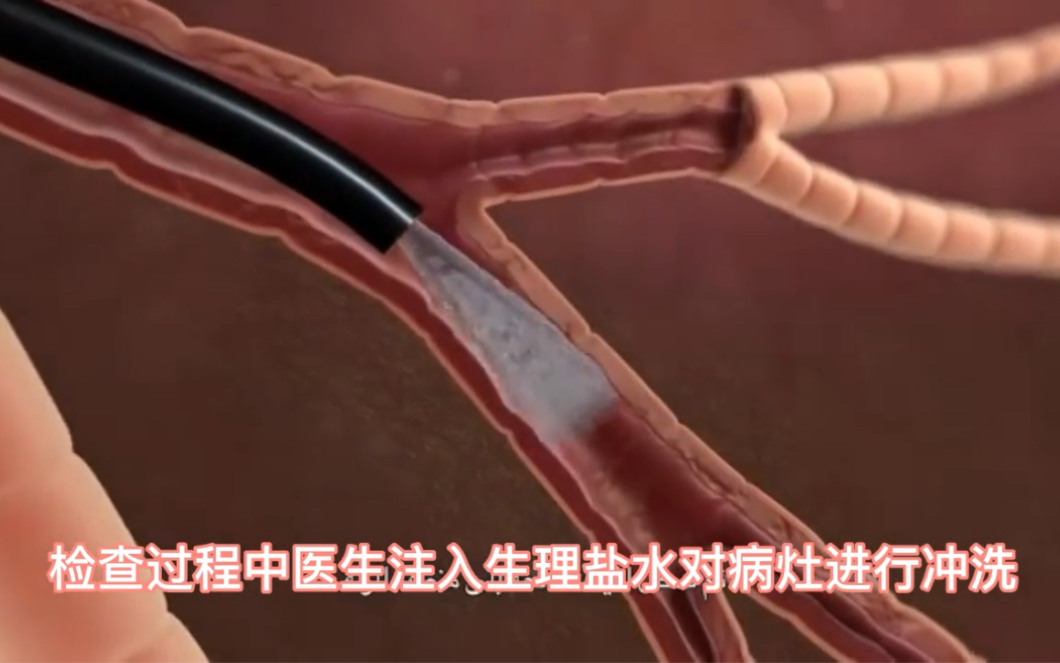 气管镜检查动画演示,过程比较痛苦!