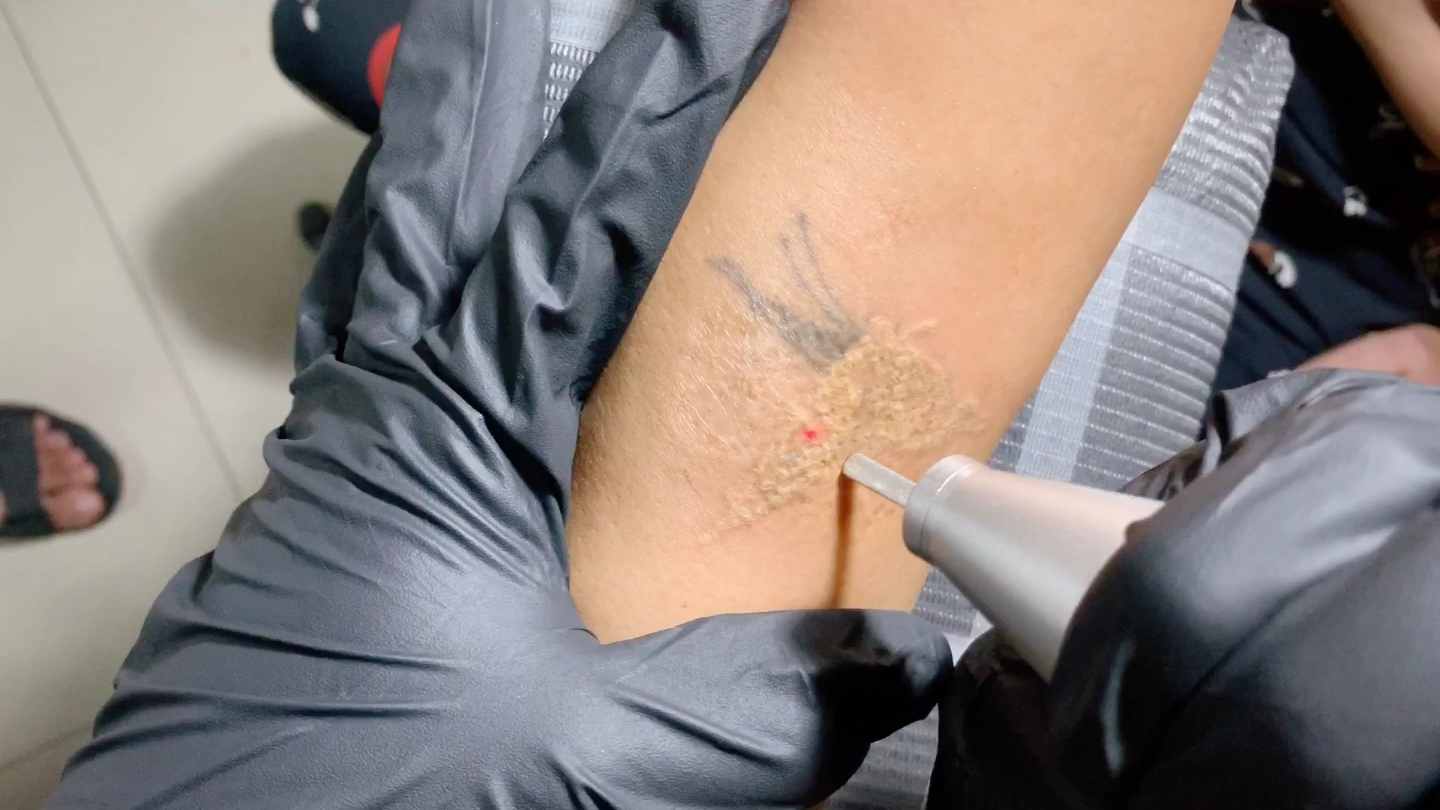 超皮秒 南昌洗纹身 南昌洗纹身哪里好 南昌专业洗纹身 皮秒激光洗纹身