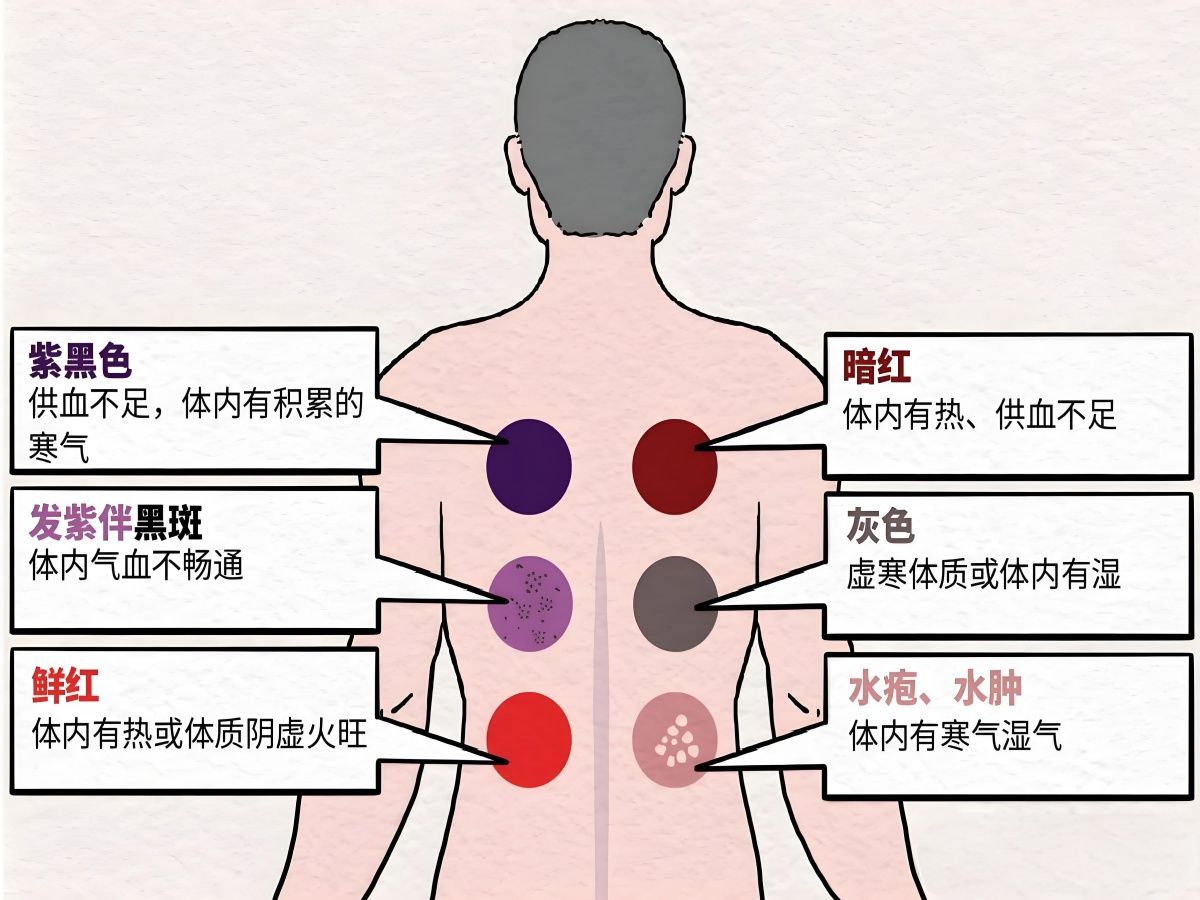 中医针灸学 — 拔罐法哔哩哔哩bilibili