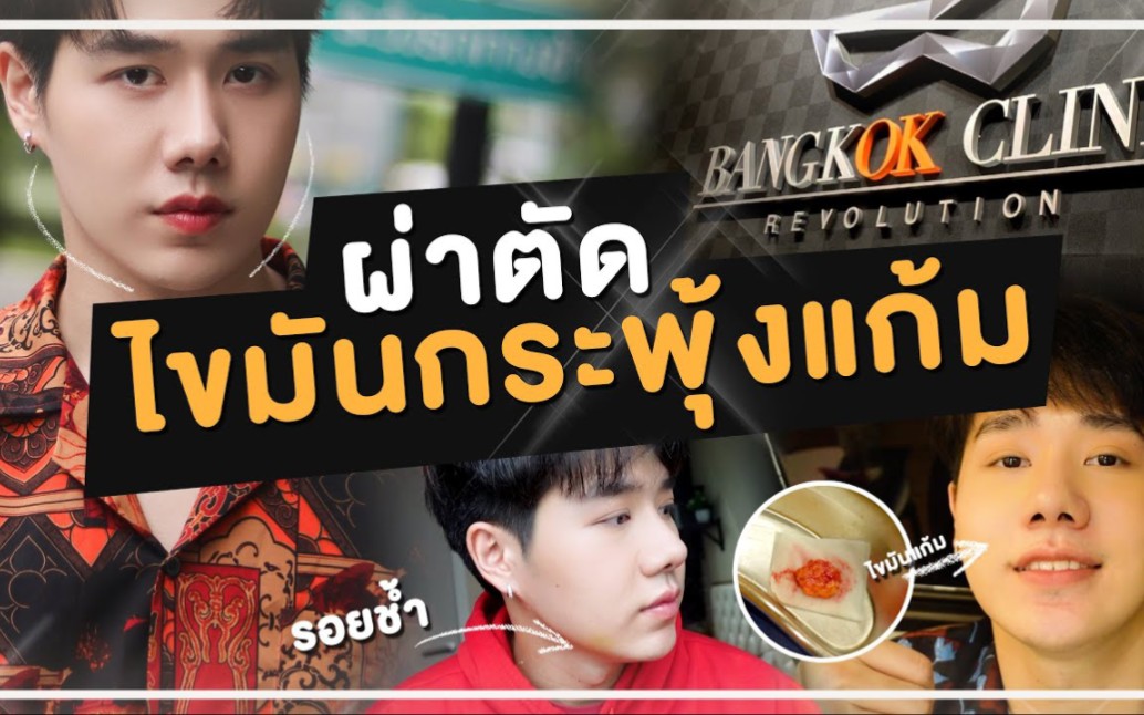 [230821] 蓝宝油管 | 人生中的重大改变"脸颊脂肪去除手术"| petch