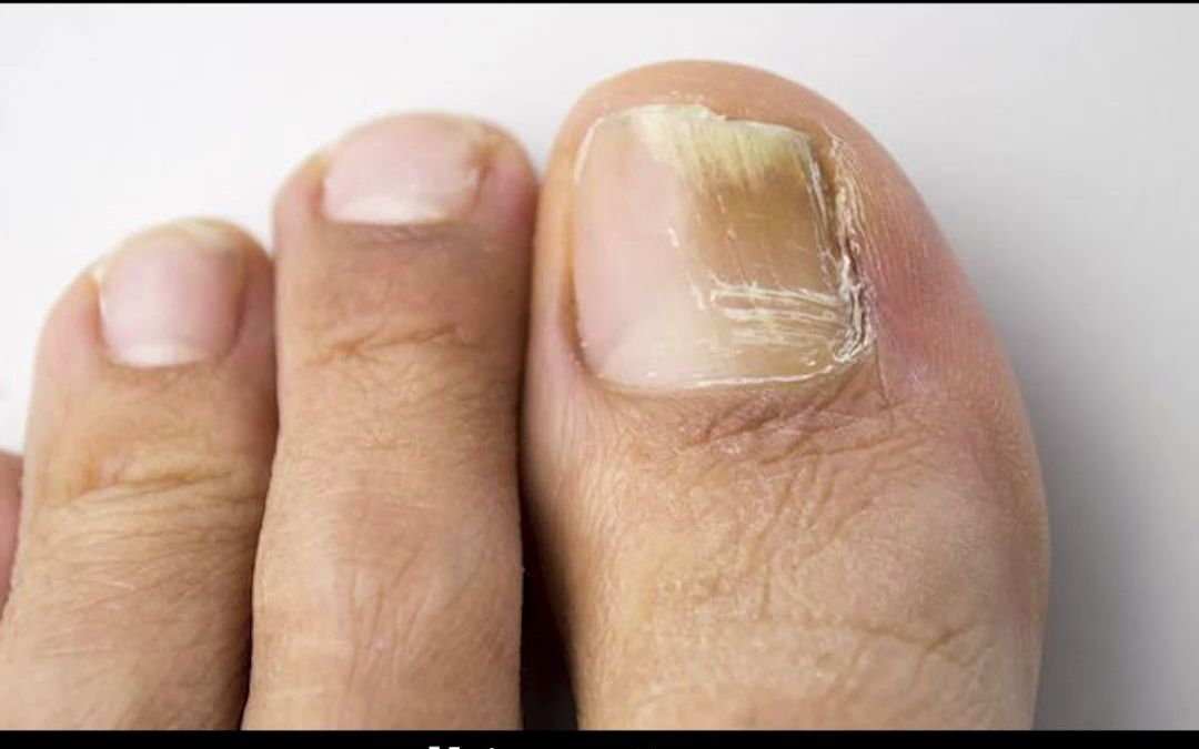 no83:脚指甲变黄变厚变形 这样处理不难!