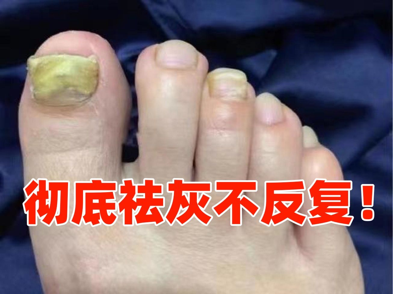 不到200就治好了灰指甲,方法竟然这么简单!