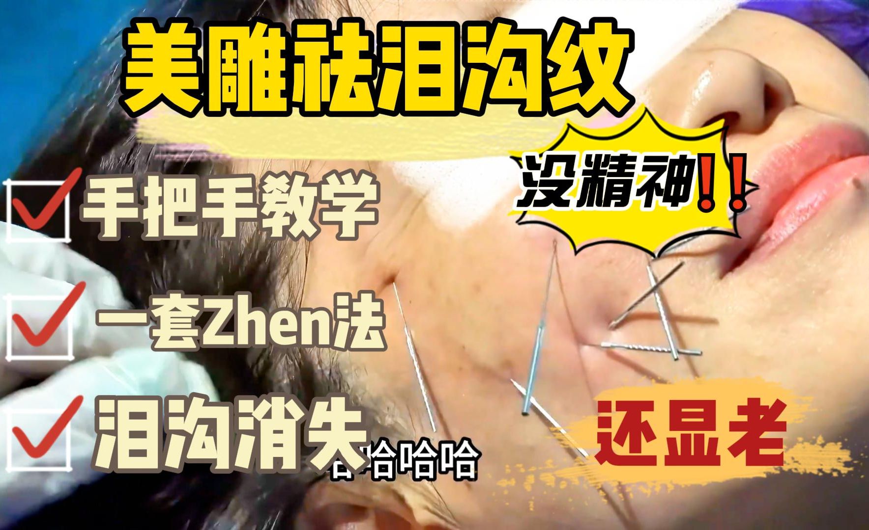 汉传针雕:泪沟深没精神还显老,王老师教你一套z法,泪沟消失更显年轻!