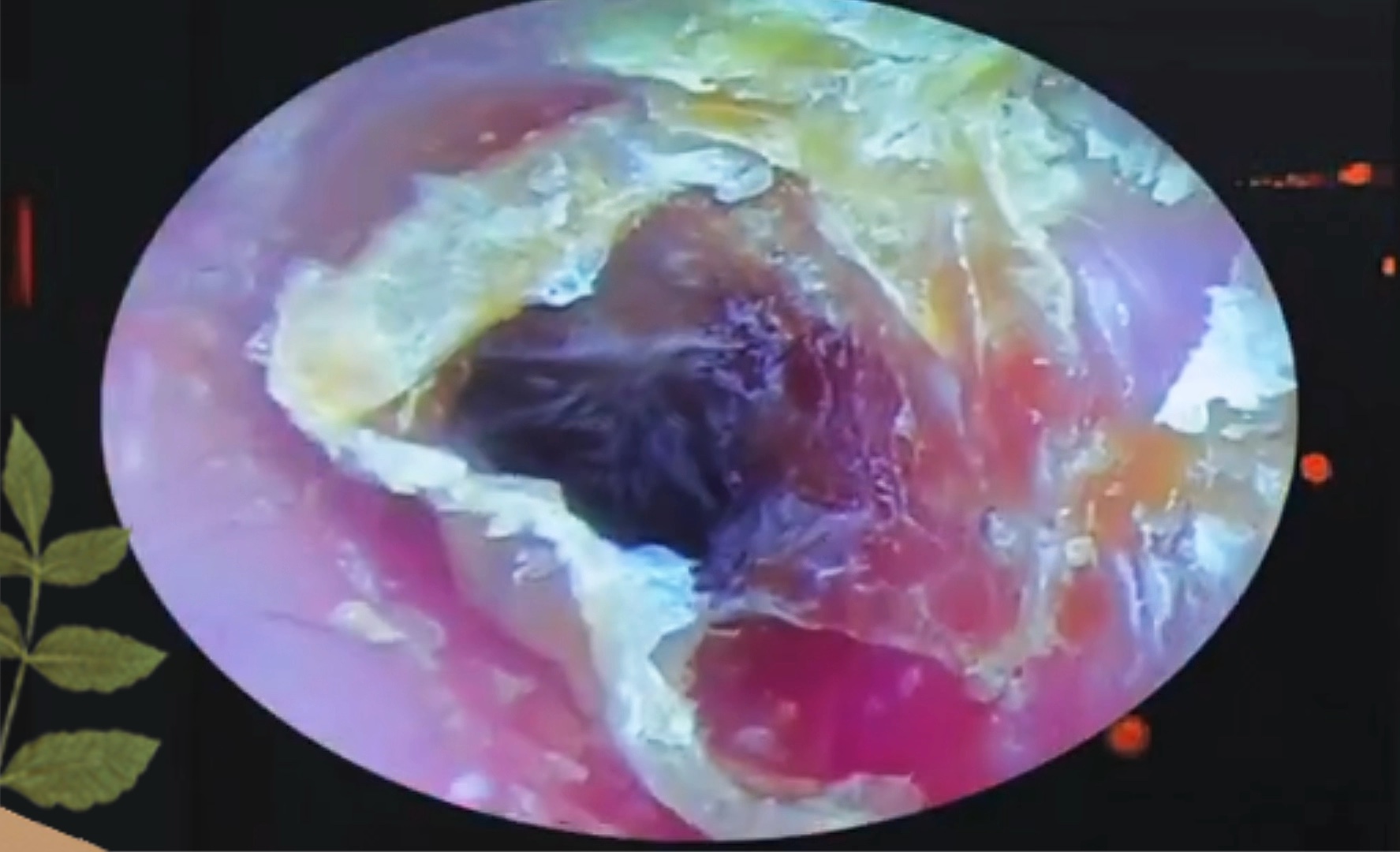 耳膜穿孔结痂图片图片