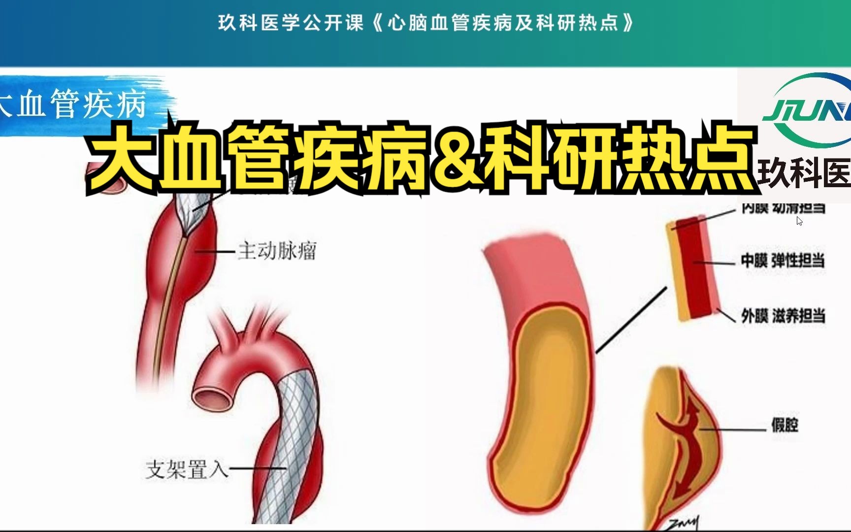 大血管疾病介绍及科研热点哔哩哔哩bilibili