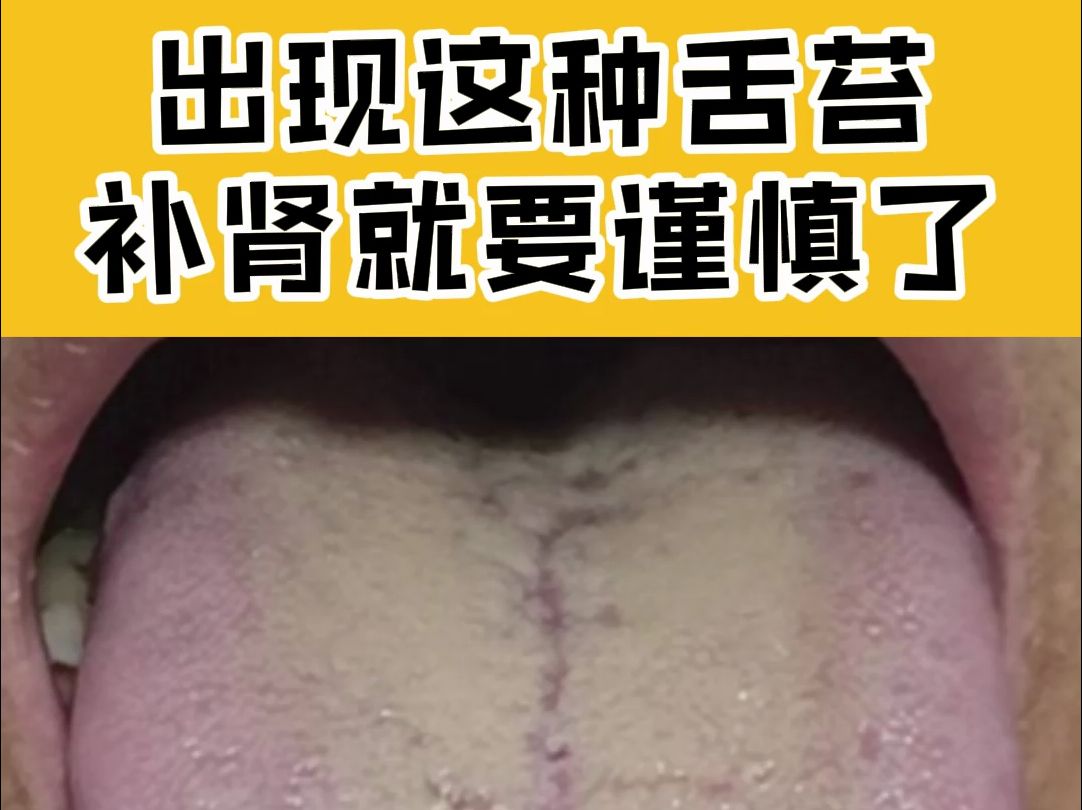 舌象分析师:像这种舌苔,补肾虚要谨慎了哔哩哔哩bilibili