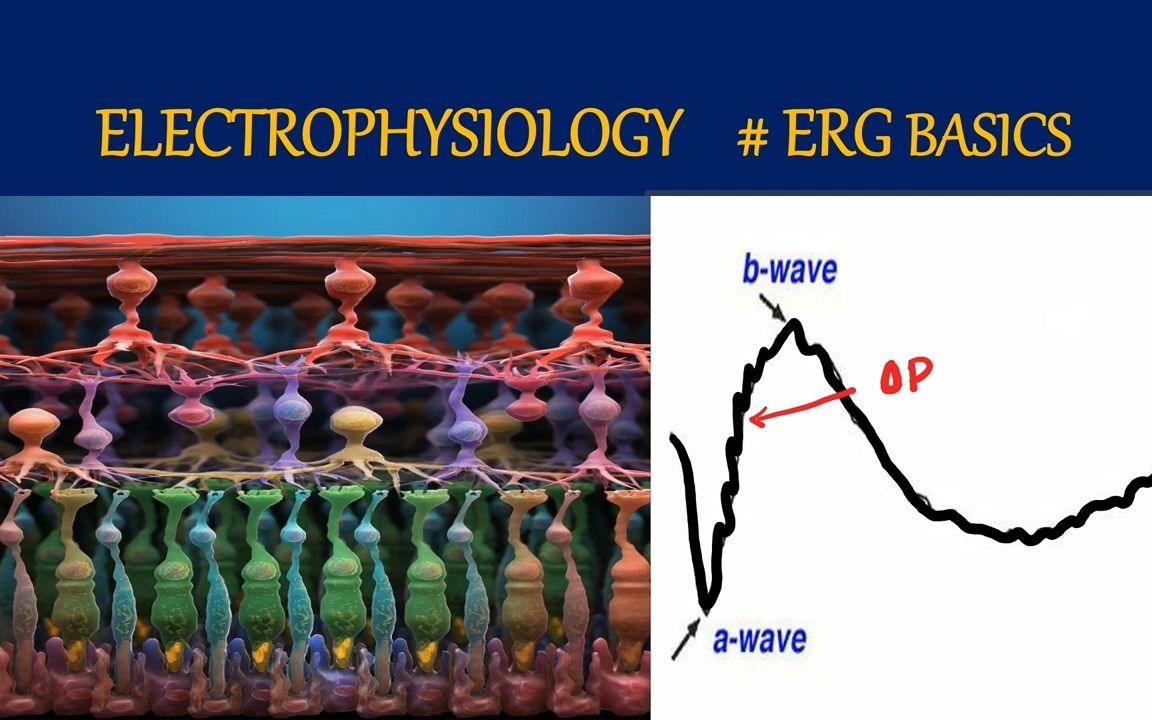 ERG waves explained|Retinal electrophysiology  眼科电生理|视网膜电图哔哩哔哩bilibili