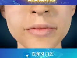 Download Video: 当遇到牙齿龋坏面积大、缺损严重、根管治疗的情况时，建议戴上牙冠保护哦！#种植牙#口腔科普@烟台壹颗芽口腔