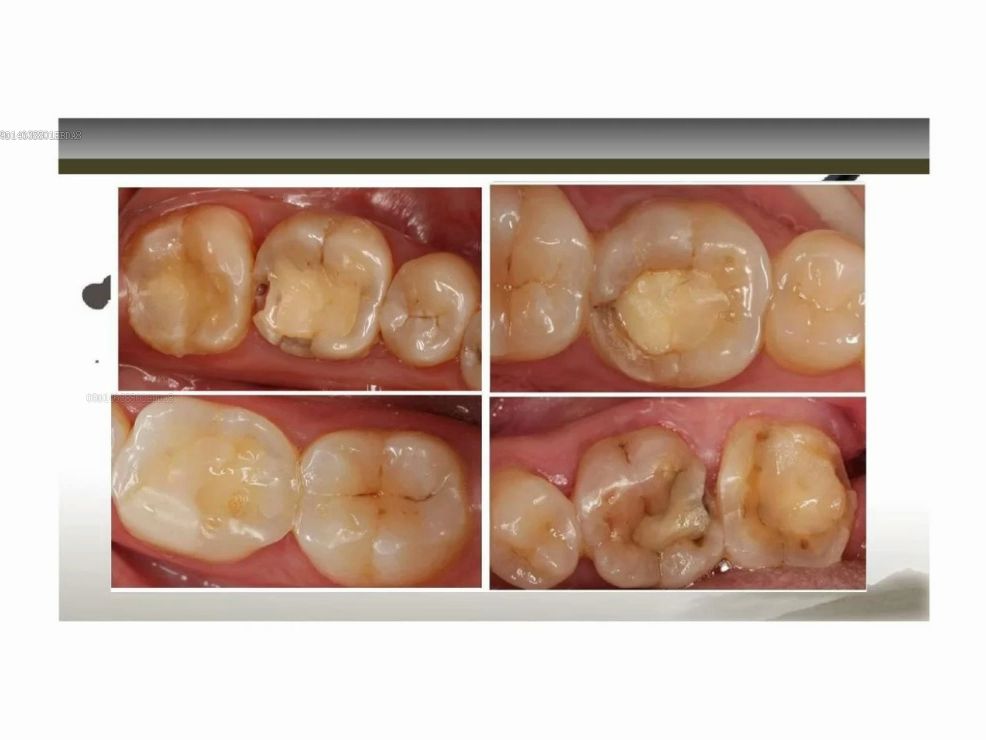 后牙美学直接修复病例解析