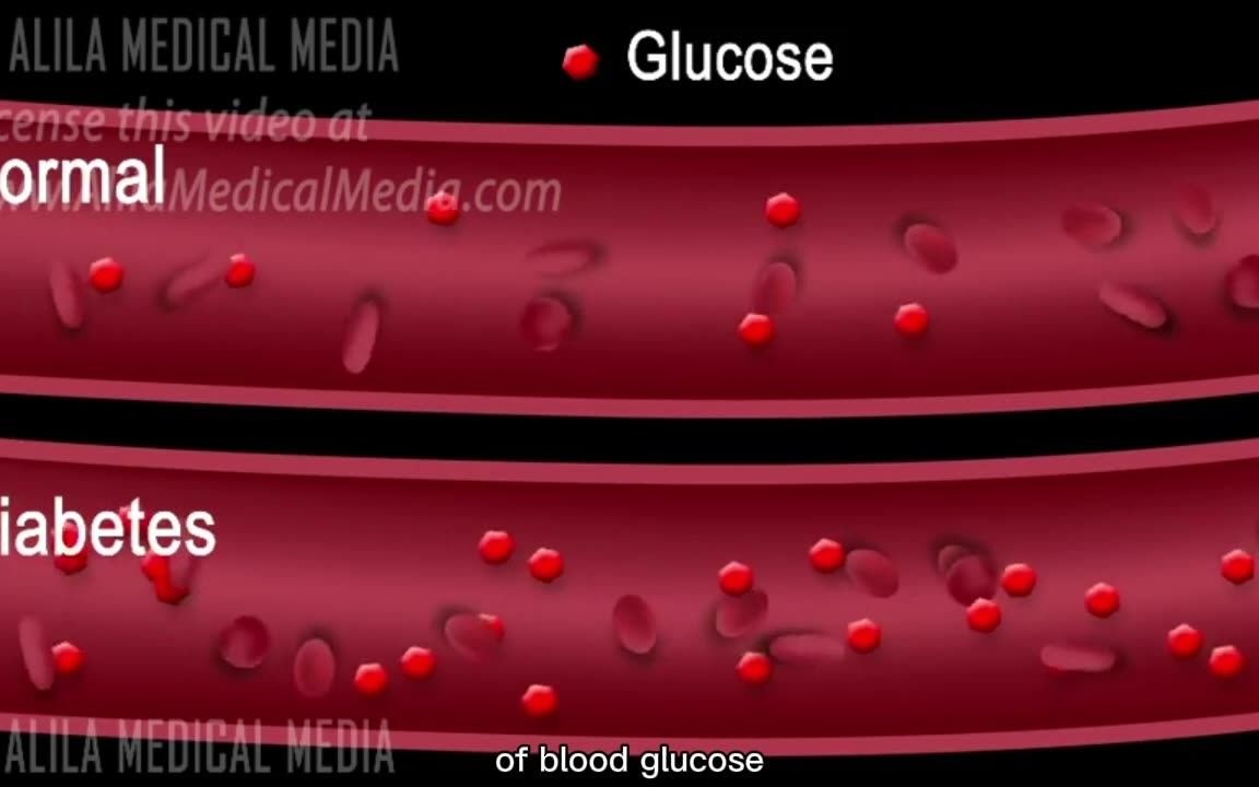 [图][英文字幕] I型与II型糖尿病介绍 Introduction to Type 1 and Type 2 Diabetes