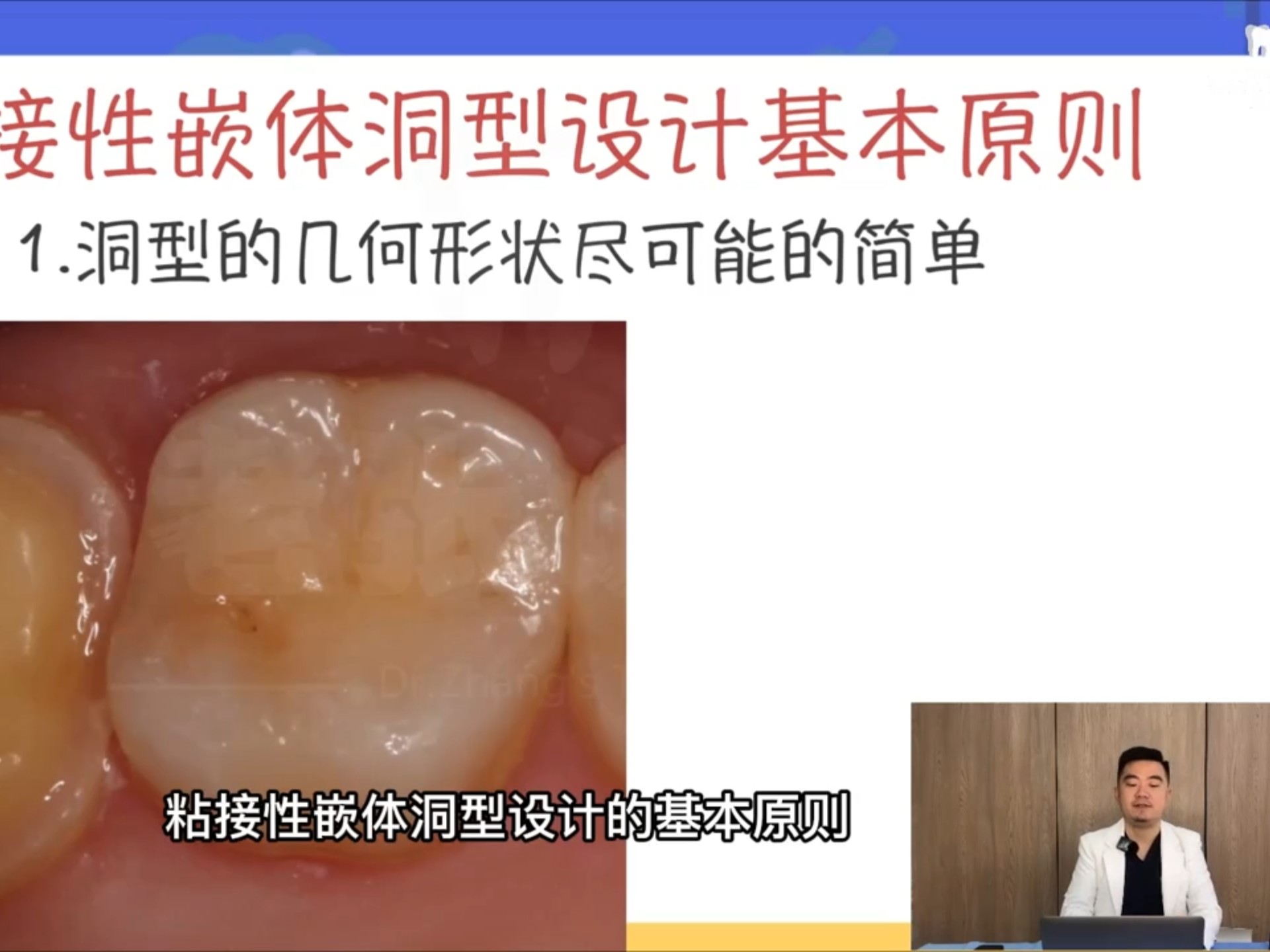 张林 后牙嵌体预备设计理论3