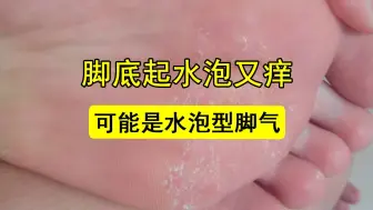 Download Video: 脚底起水泡又痒又脱皮，这是水泡型脚气教你简单去除