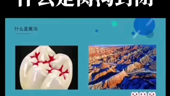 窝沟封闭的重要性哔哩哔哩bilibili