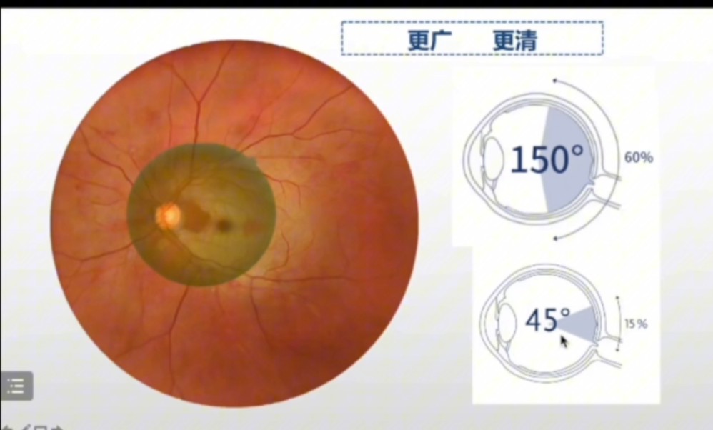 What's Up之眼底照相/欧宝/超广角/眼内角/150度/45度 丁小燕哔哩哔哩bilibili