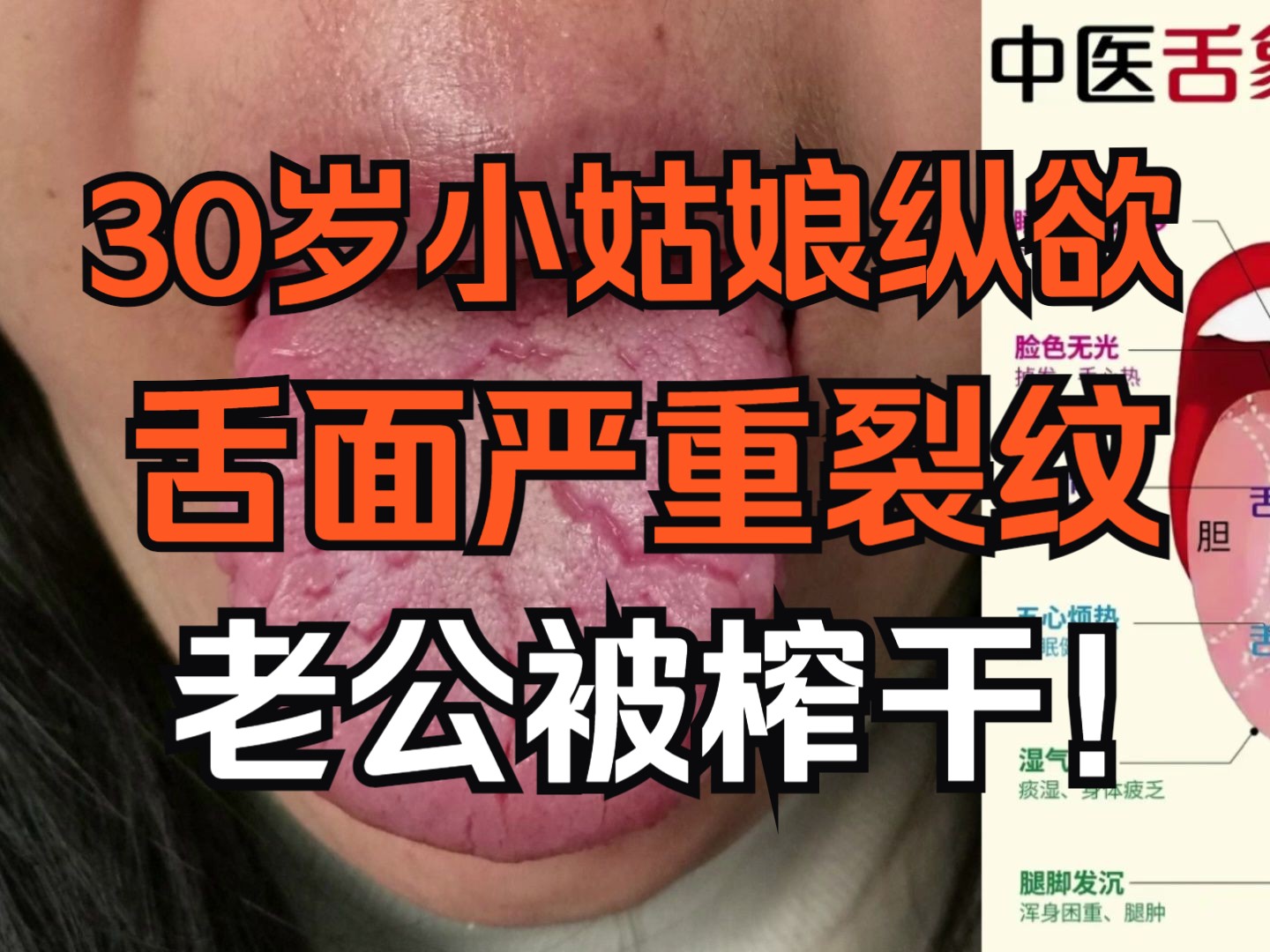 30岁小姑娘欲望大,爱看小电影纵欲过度,导致舌面严重裂纹!哔哩哔哩bilibili