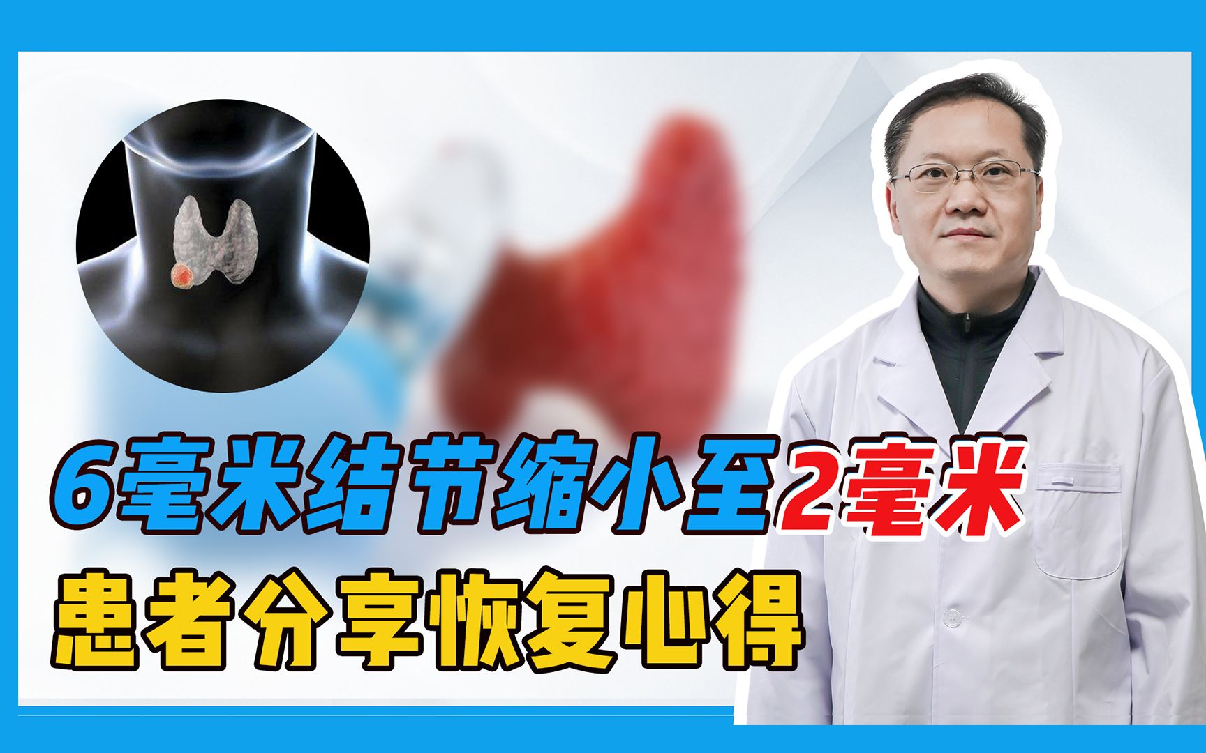 6毫米结节缩小至两毫米是如何做到的?患者分享恢复心得哔哩哔哩bilibili