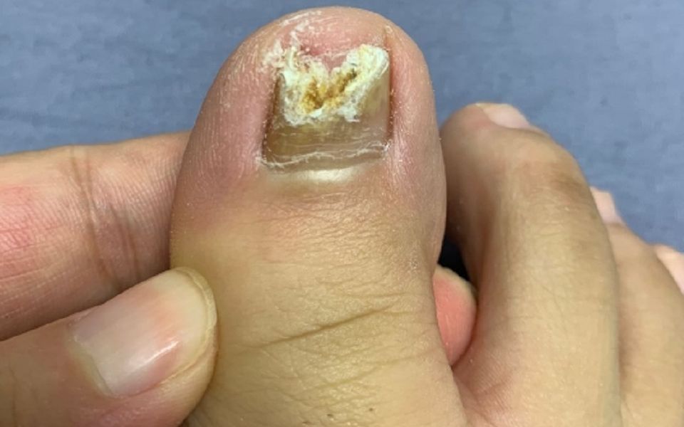 春夏指甲增厚还掉渣!提前掌握3个祛灰妙招,顽固灰甲秒脱落!