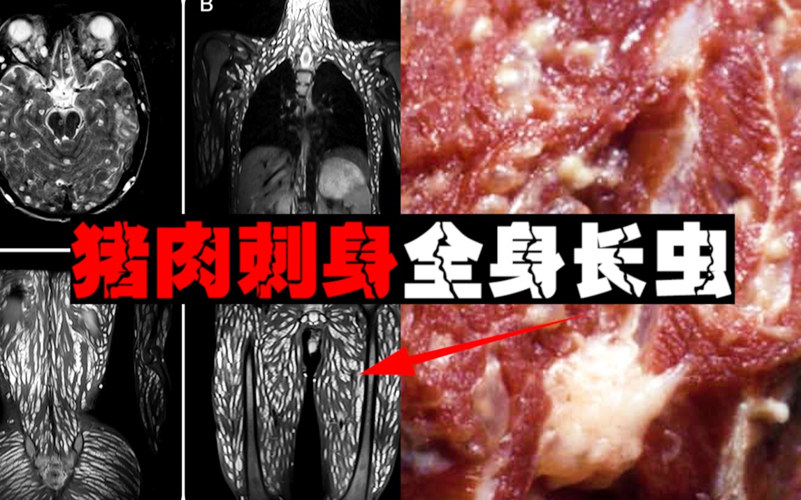 [图]【猪绦虫病】生食猪肉后病痛全身，人体扫描呈星空状