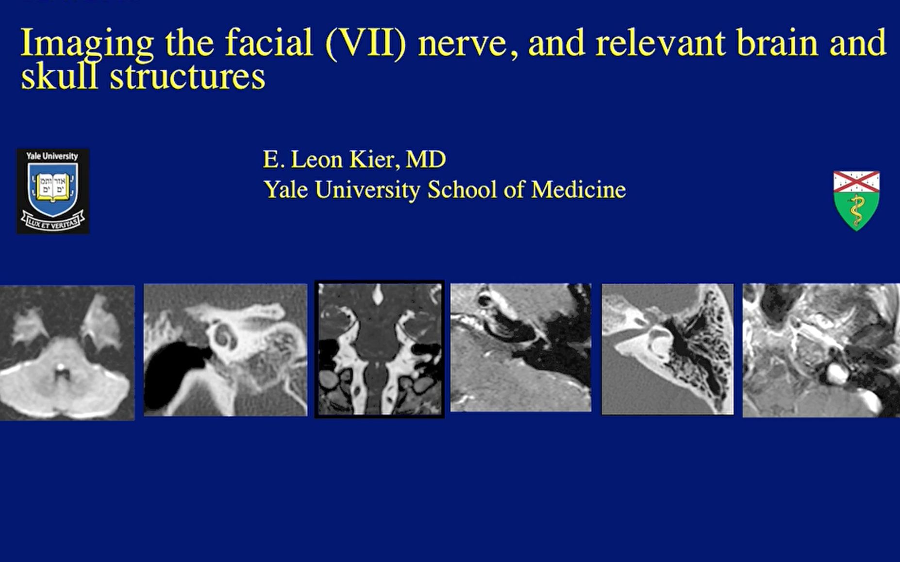 [图]颅神经影像——面神经，（耶鲁大学医学院），Facial nerve