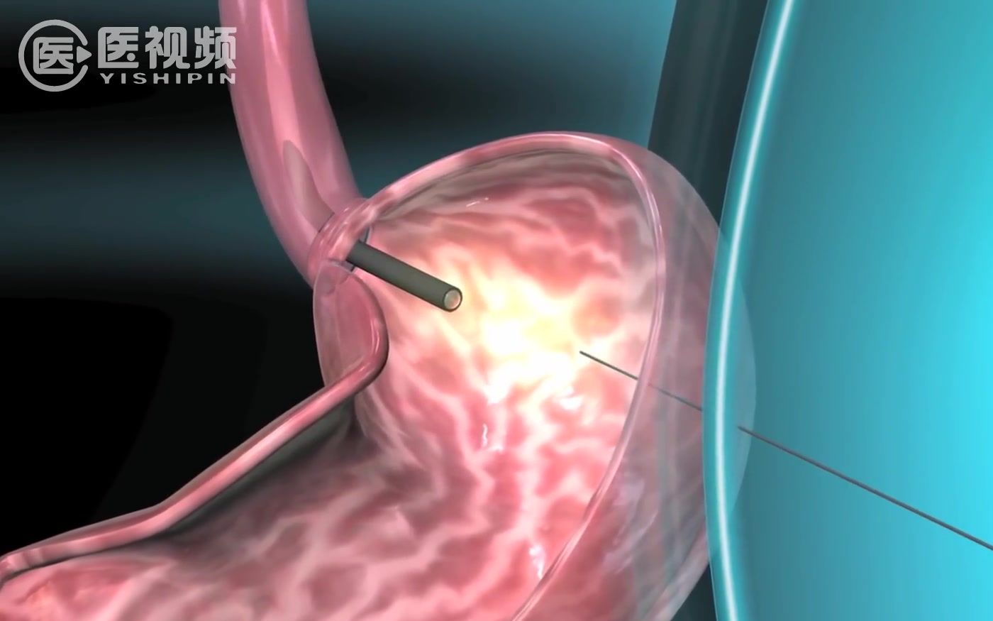 【医学双语视频】经皮内镜引导下胃造瘘术(PEG)哔哩哔哩bilibili