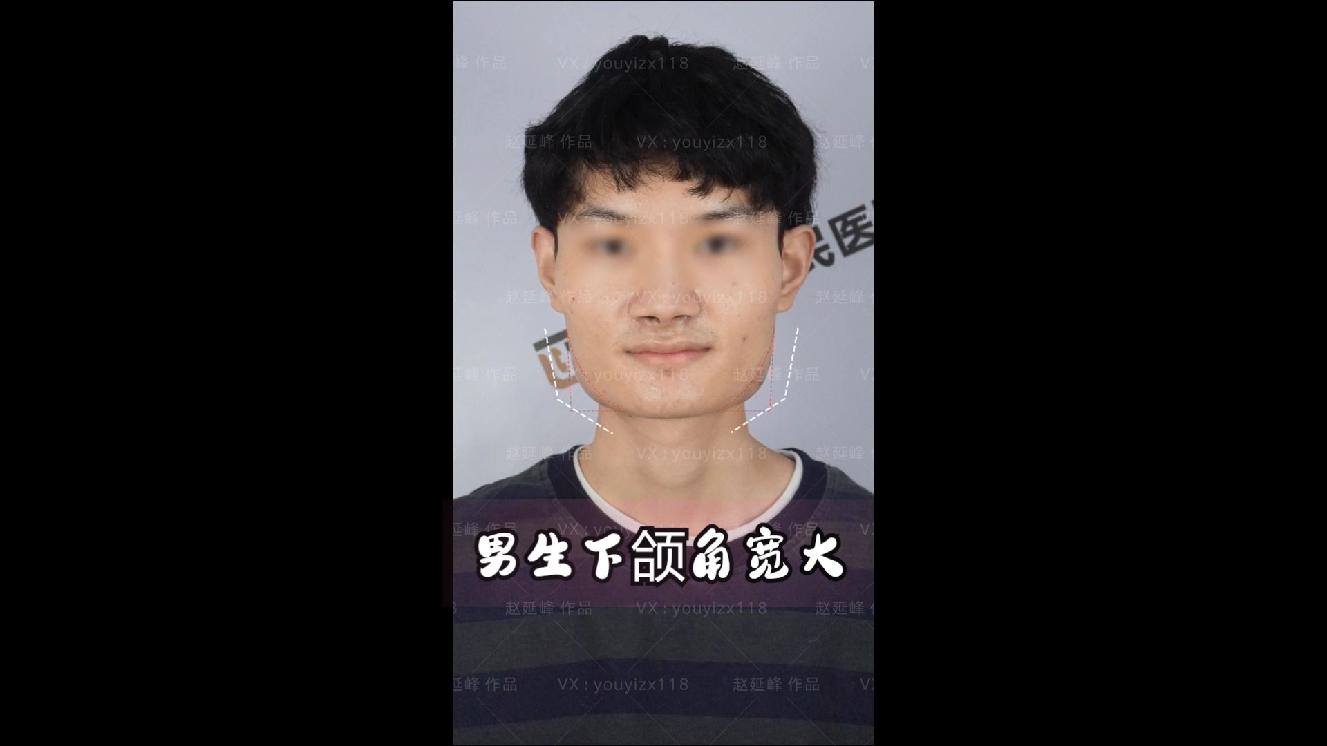 26岁男生调整下颌角宽大哔哩哔哩bilibili