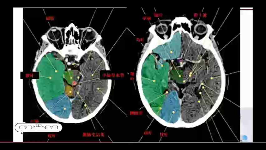 [图]全身CT诊断与报告书写讲解：头颅CT断层解剖图谱分享，如何书写诊断报告