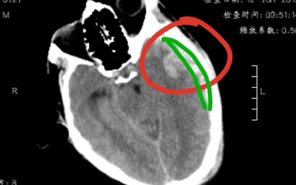 [图]自学用《医学影像诊断学》神经系统知识点复习～1~脑梗死