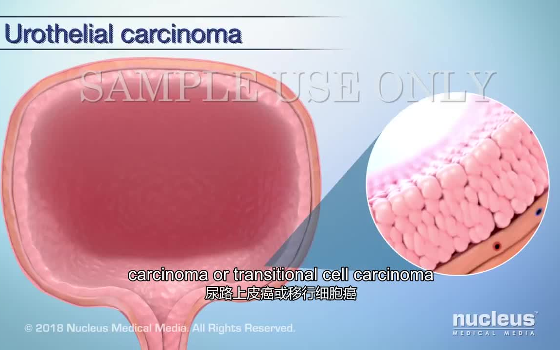 【Nucleus医学科普】3分钟了解膀胱癌哔哩哔哩bilibili