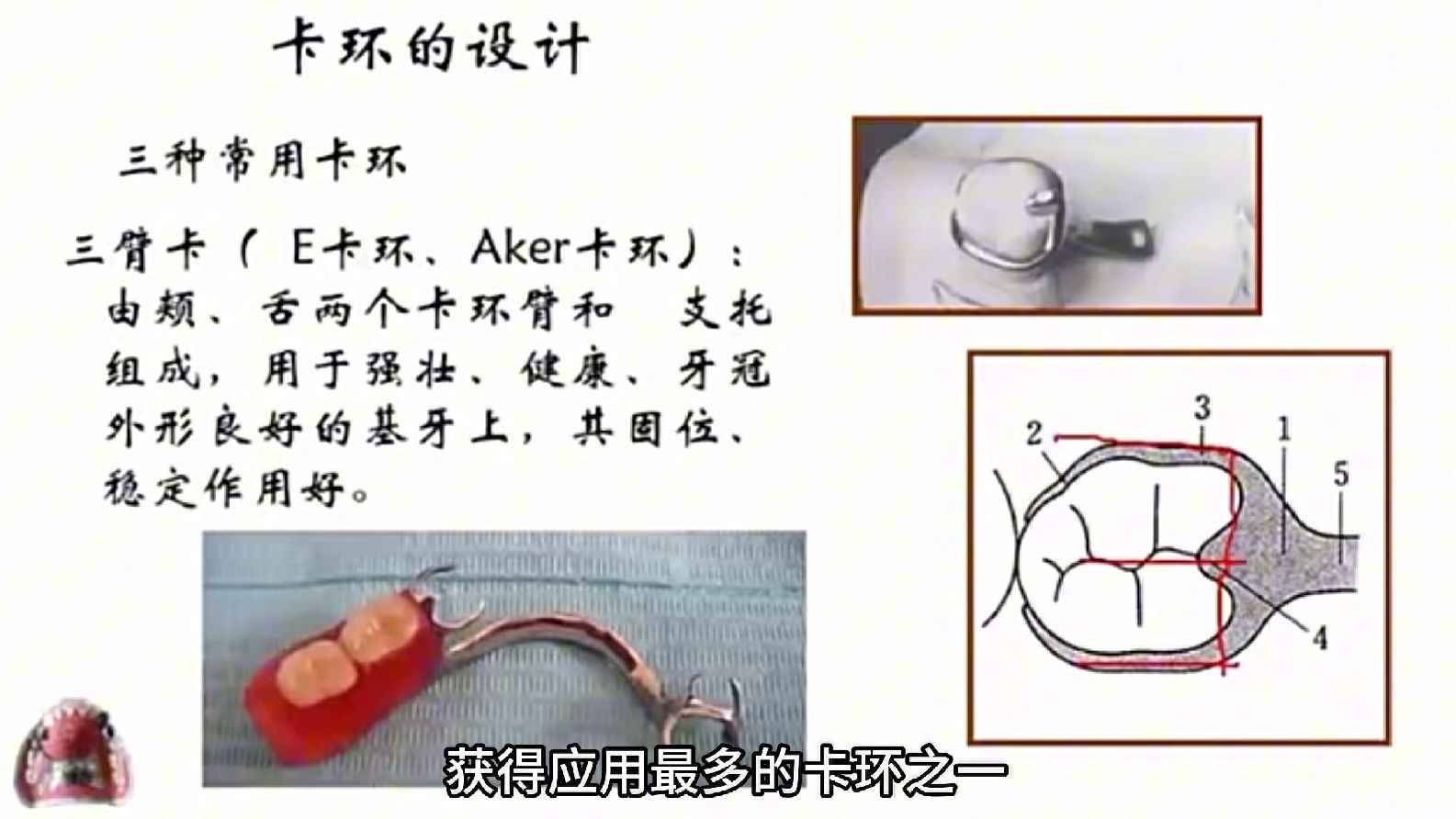 设计思路——从零开始学活动义齿1哔哩哔哩bilibili