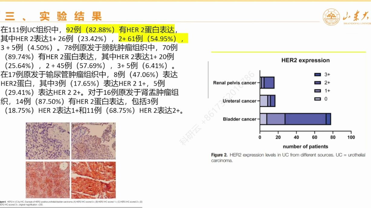 20240429山东第一医科大学常耀HER2在尿路上皮癌中的表达及其意义哔哩哔哩bilibili