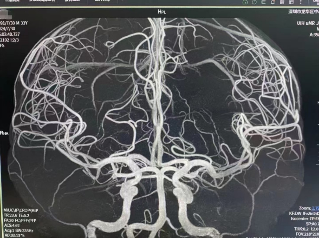 ct下肢血管 pc法足静脉 脊髓动脉(病例来自外院老师,侵删)