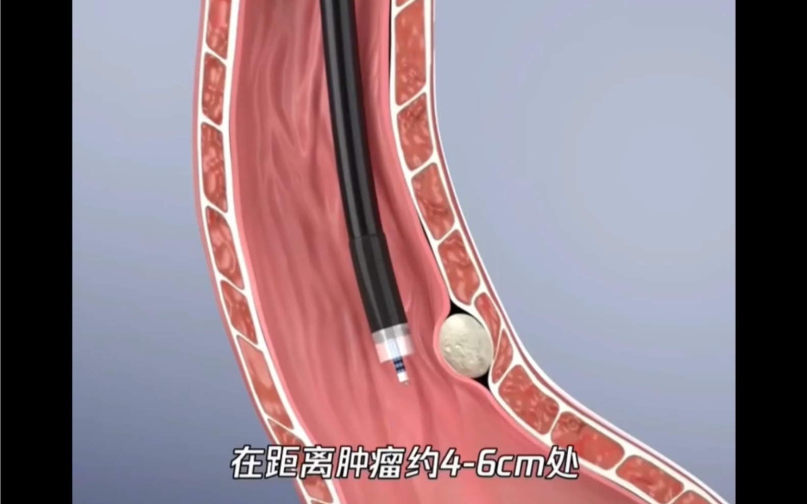 3d动画演示:经内镜粘膜下隧道肿瘤切除术