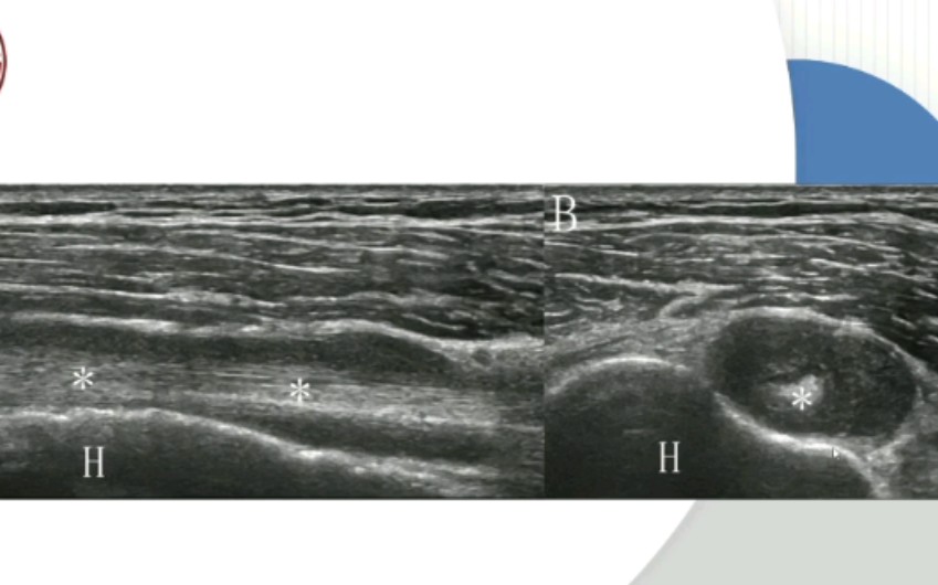 【肌骨超声】肱二头肌长头腱常见病哔哩哔哩bilibili