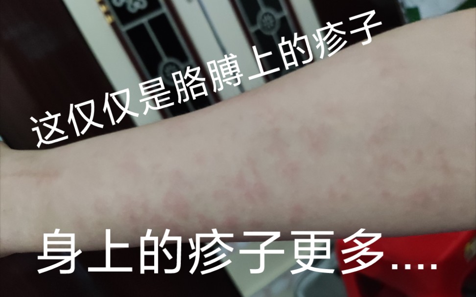 阿莫西林过敏........很折磨哔哩哔哩bilibili