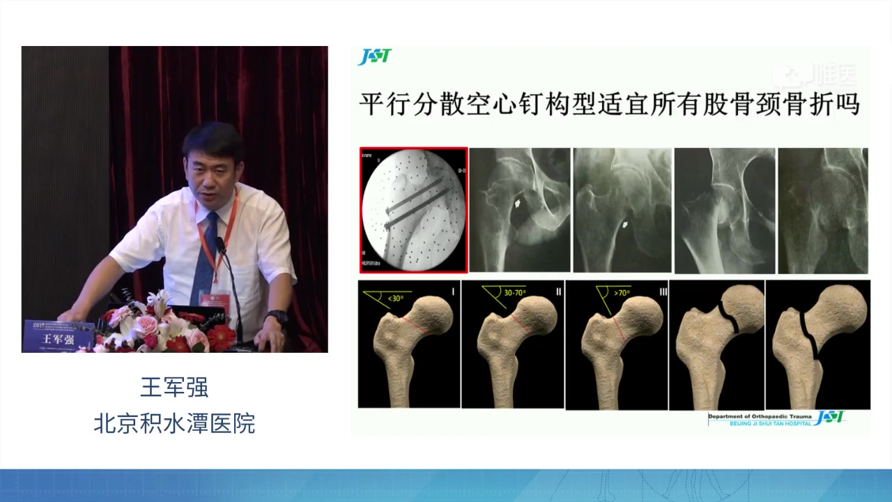 手术机器人治疗股骨颈骨折研究进展医学视频唯医,allinmd哔哩哔哩bilibili