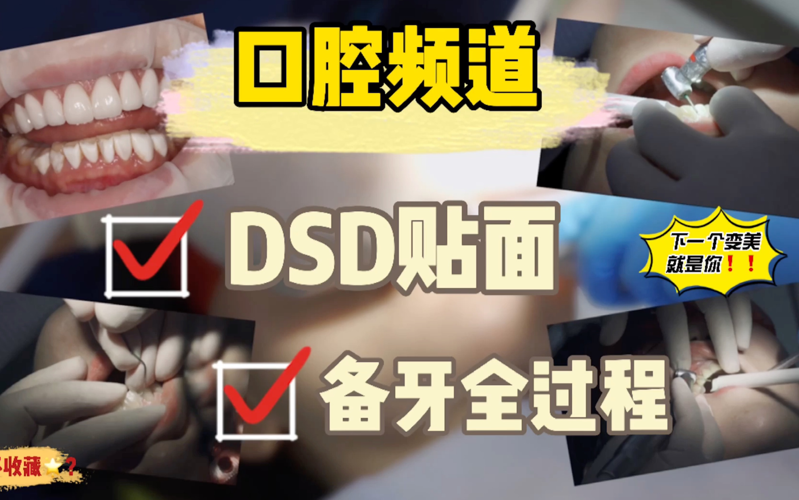 [图]DSD贴面备牙全过程