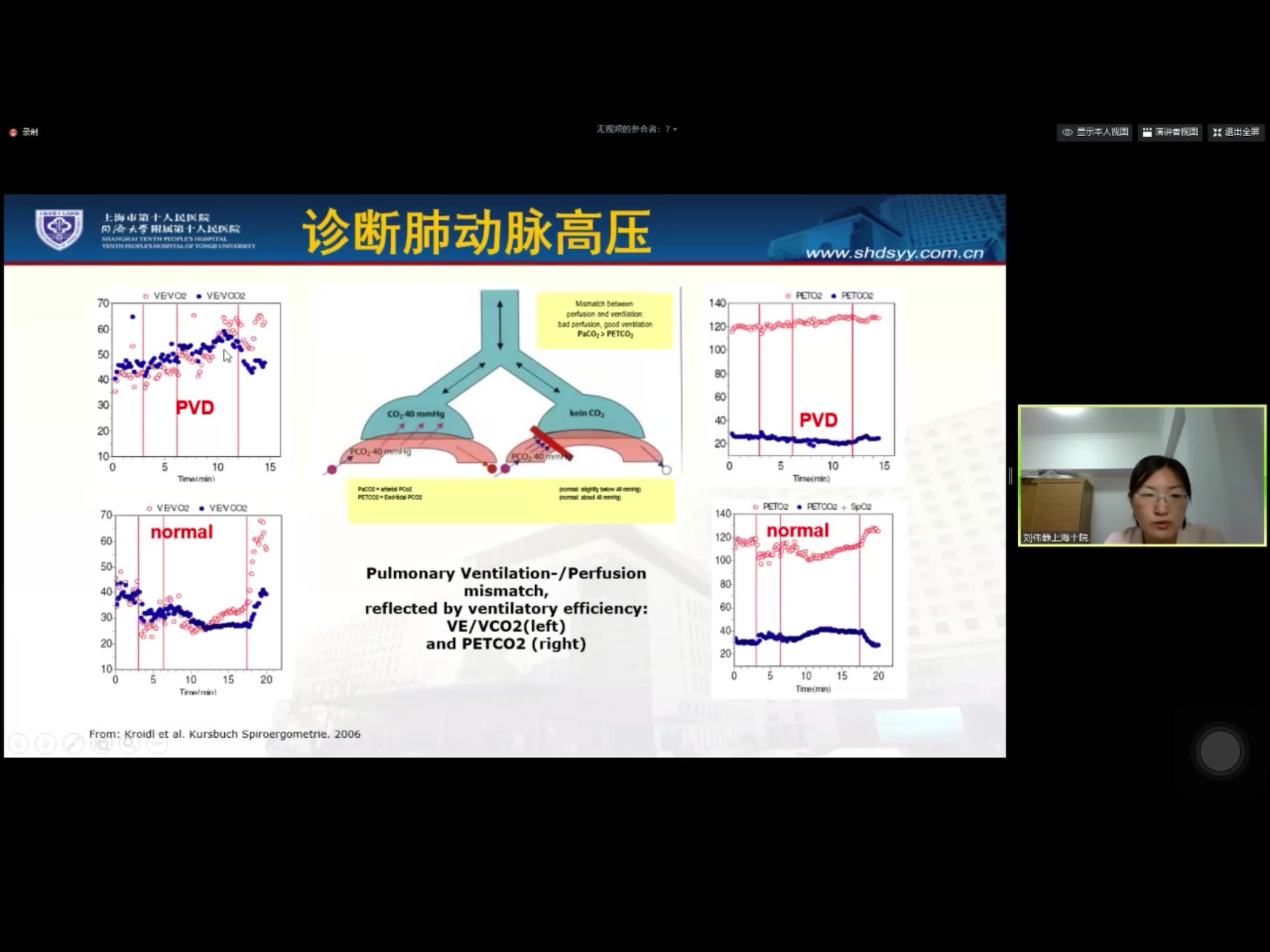 肺动脉高压CPET分析 同济附属十院 刘伟静 徐亚伟哔哩哔哩bilibili