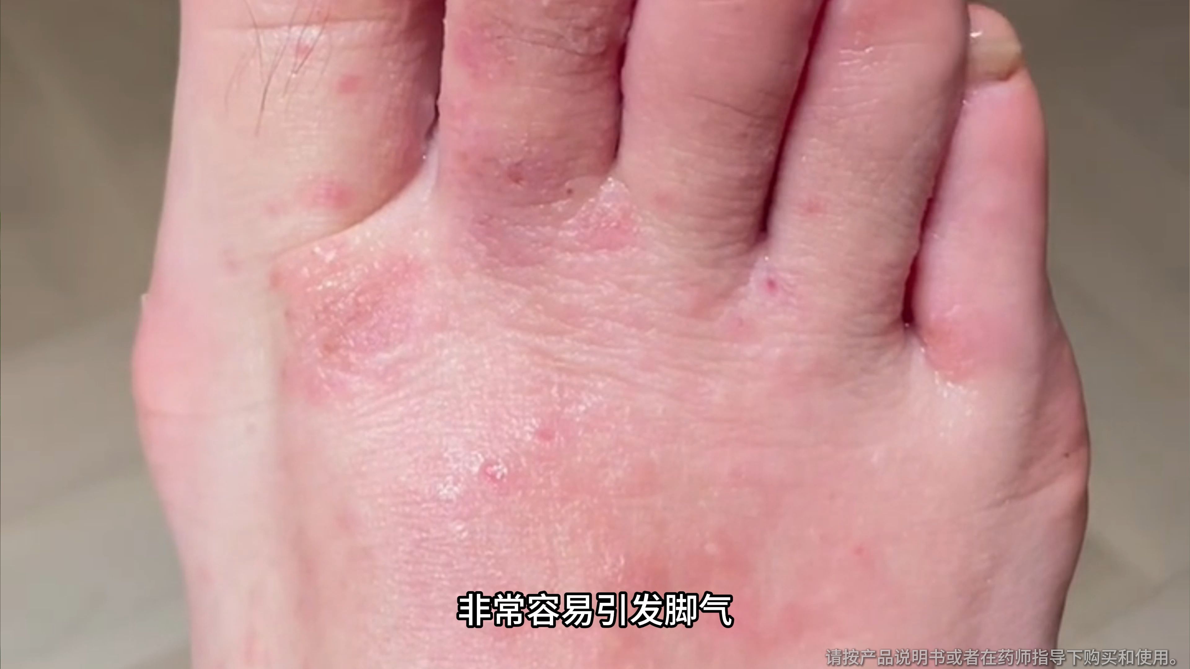 别再抠脚了!小心全身感染脚气