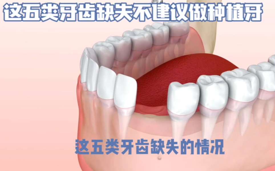 这五类牙齿缺失的情况,不建议做种植牙哔哩哔哩bilibili