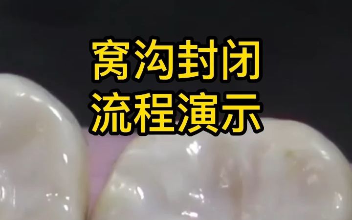 窝沟封闭流程演示哔哩哔哩bilibili