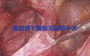 下载视频: 腹腔镜下腹股沟疝修补术