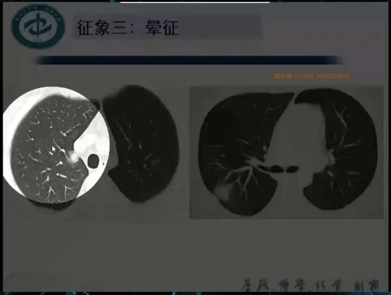 [图]新冠肺炎影像诊断